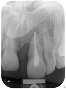 Stoian_Aurelia_Light box(1)_Intraoral_20170106_194625
