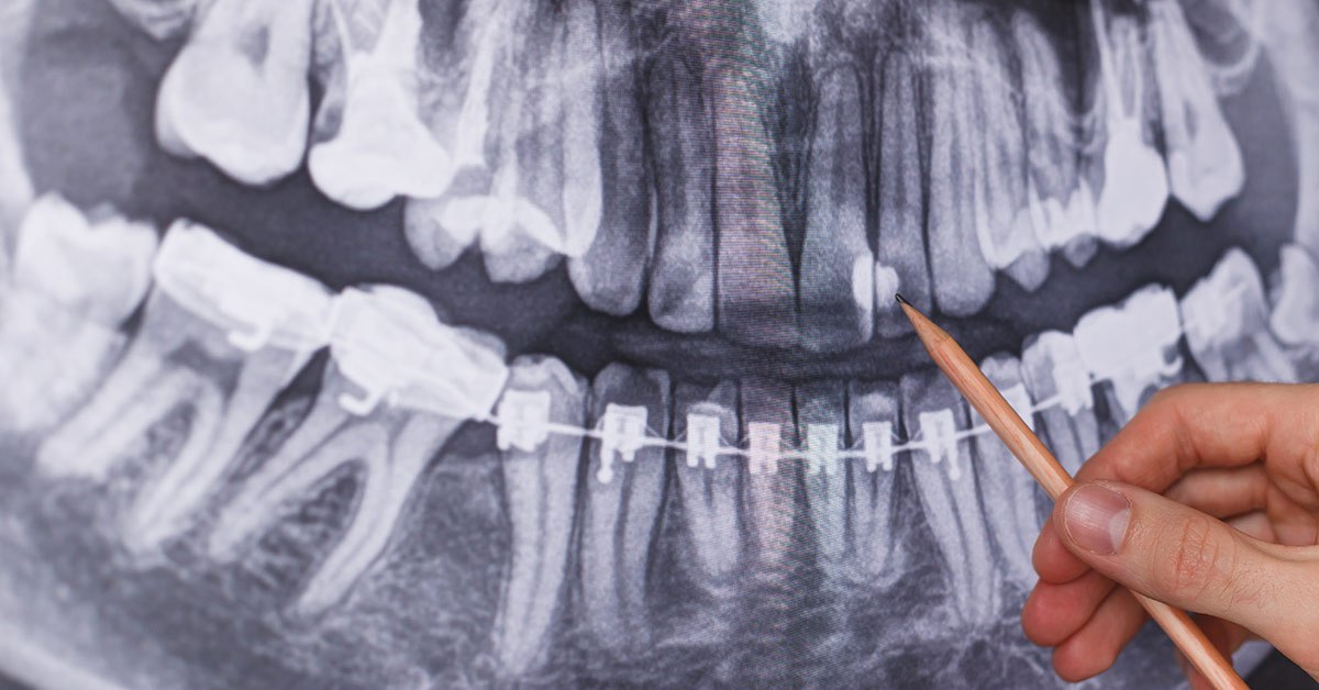 radiografie-dentara
