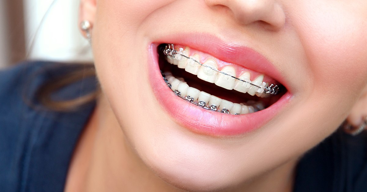 Aparat dentar din safir la Trident