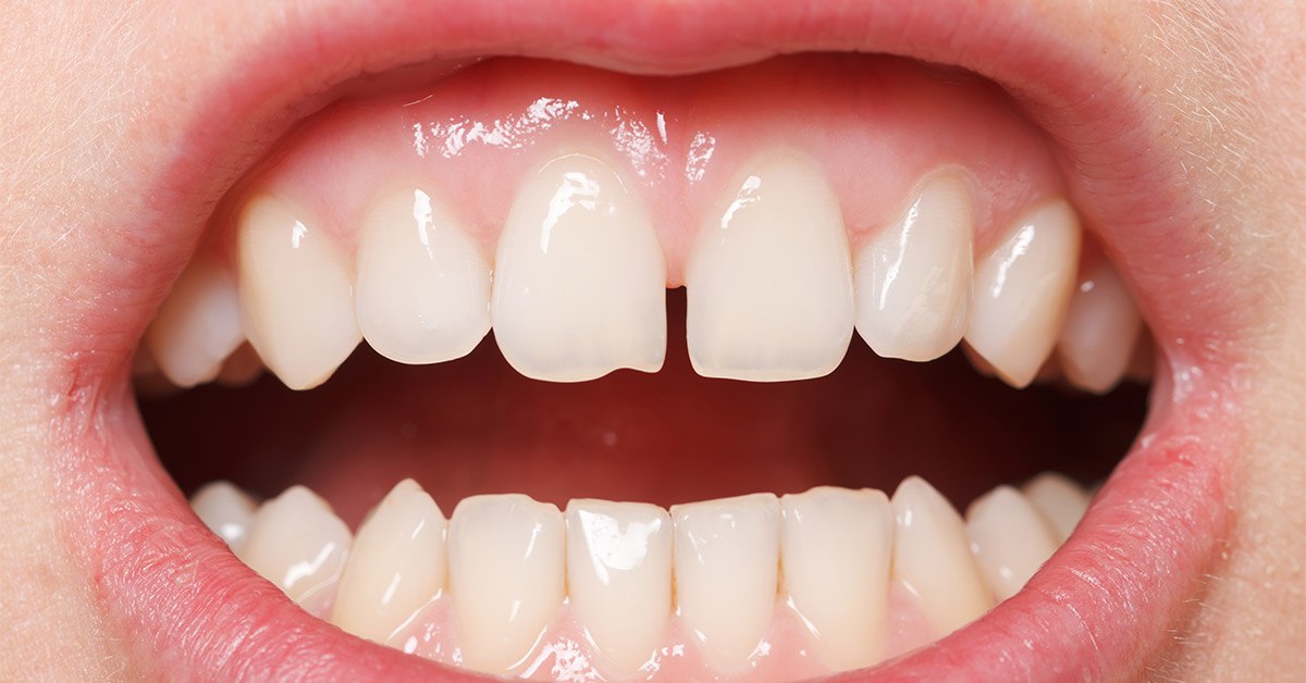 diastema-tratament-trident