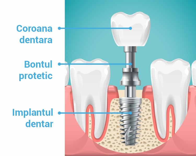 componentele implantului dentar trident