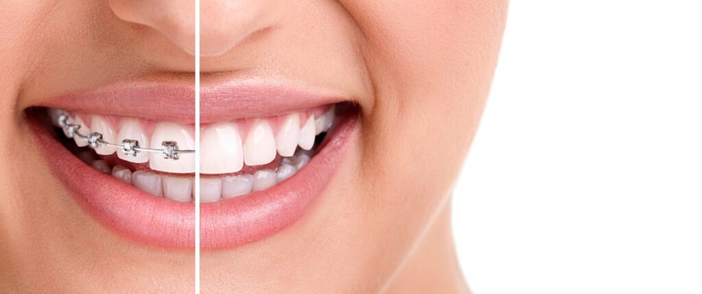 Bracket dentar, aparat, clinicile Trident