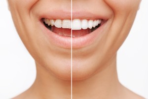 Restaureaza-ti zambetul cu fatete ceramice la clinica Trident