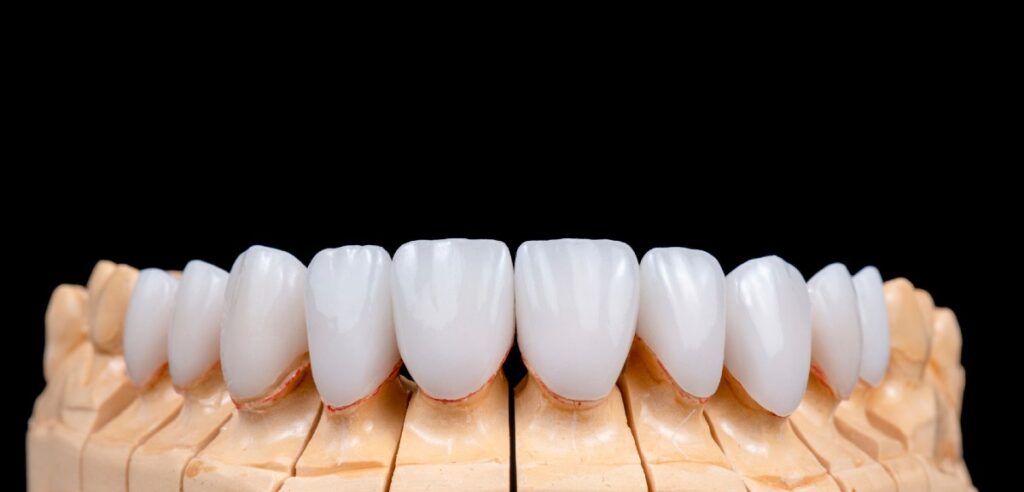 Fatete dentare Emax, Trident
