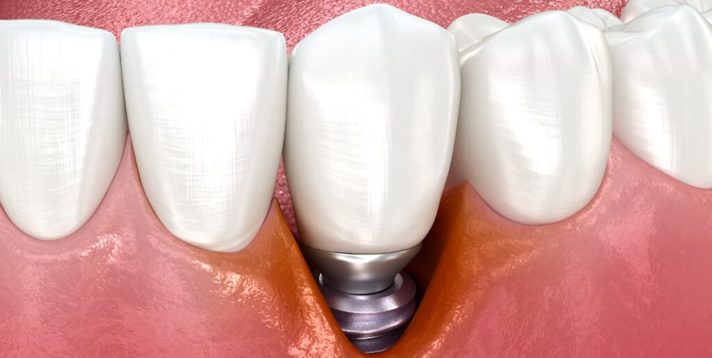 Periimplantita, exemplificare pe o dantura, Trident Bucuresti